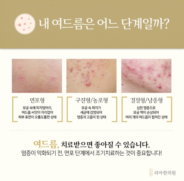 면포형·구진형·농포형·결절형 여드름 단계를 구분한 안내 이미지