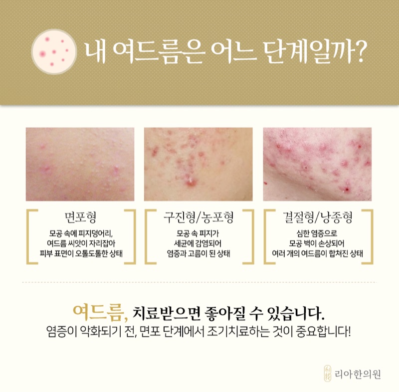 면포형·구진형·농포형·결절형 여드름 단계를 구분한 안내 이미지