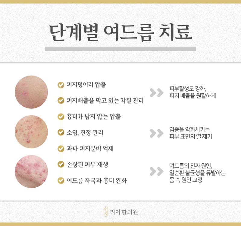피부 상태에 따라 달라지는 단계별 여드름 치료 안내 이미지
